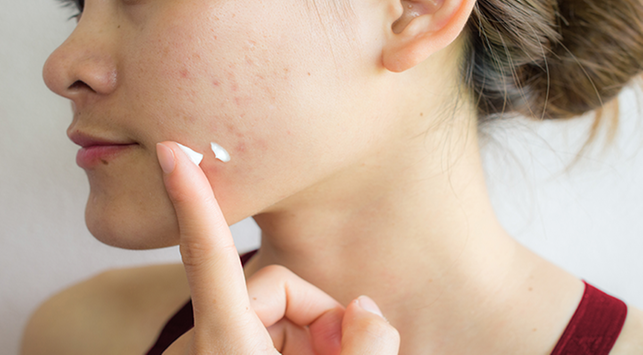 Ciri-Ciri Radang Kulit Akibat Skincare yang Tidak Cocok dan Cara Menghindarinya