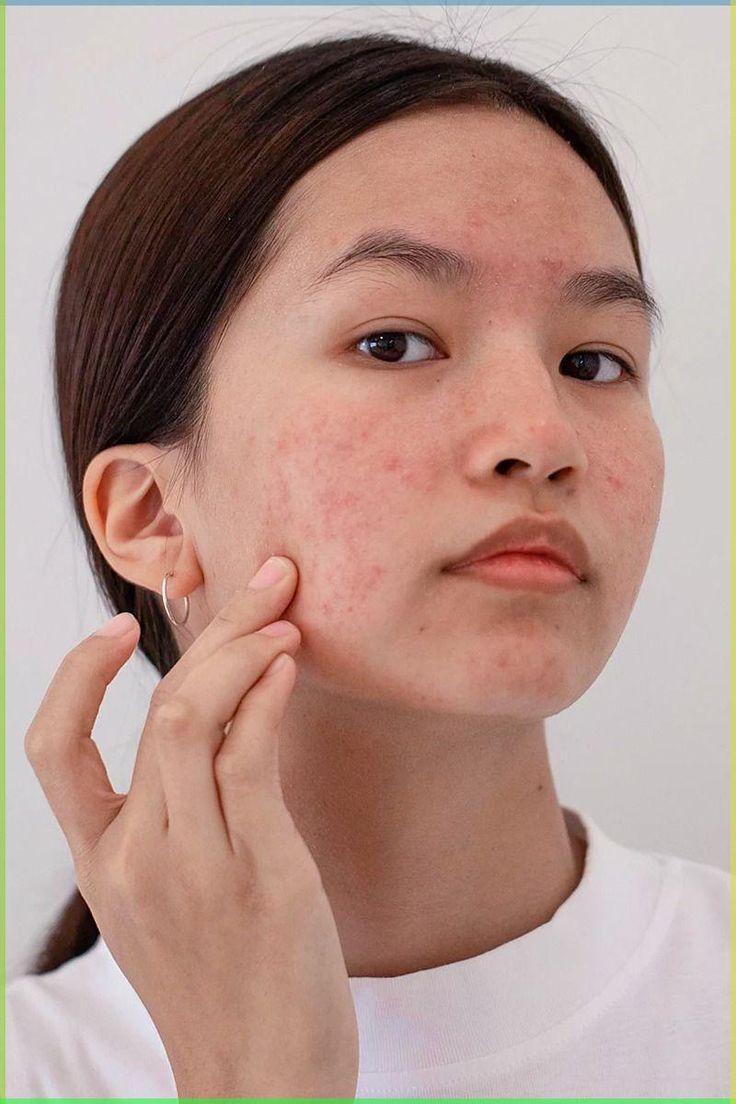 Ternyata Ini Alasan Jerawat Meradang Tak Pernah Sembuh Meski Sudah Diobati!