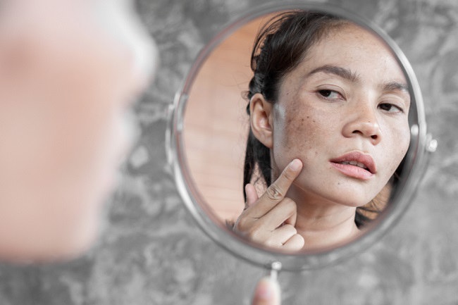 Rekomendasi Treatment untuk Menghilangkan Flek Hitam Secara Efektif