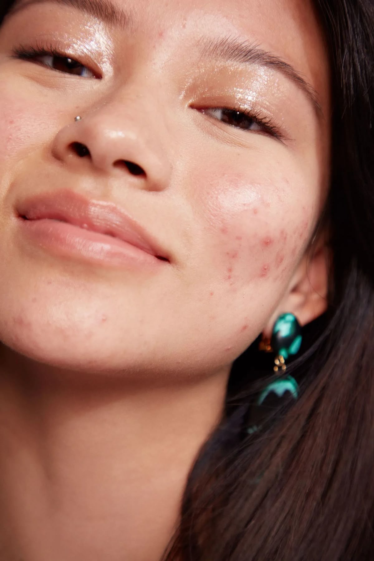 Facial Acne, Perawatan Favorit untuk Kulit Berjerawat